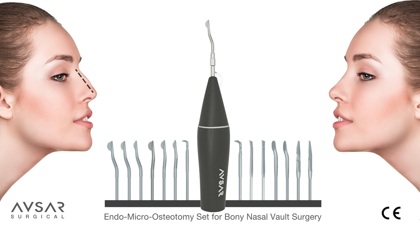 Video Endoscopic Micro Rhinoplasty RhinoSculpture | Avsar Surgical